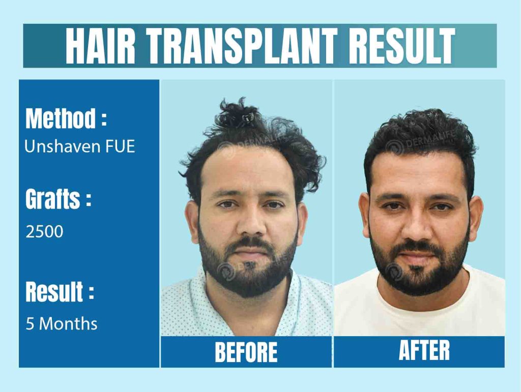 Best Hair Transplant Clinic in Delhi, India
