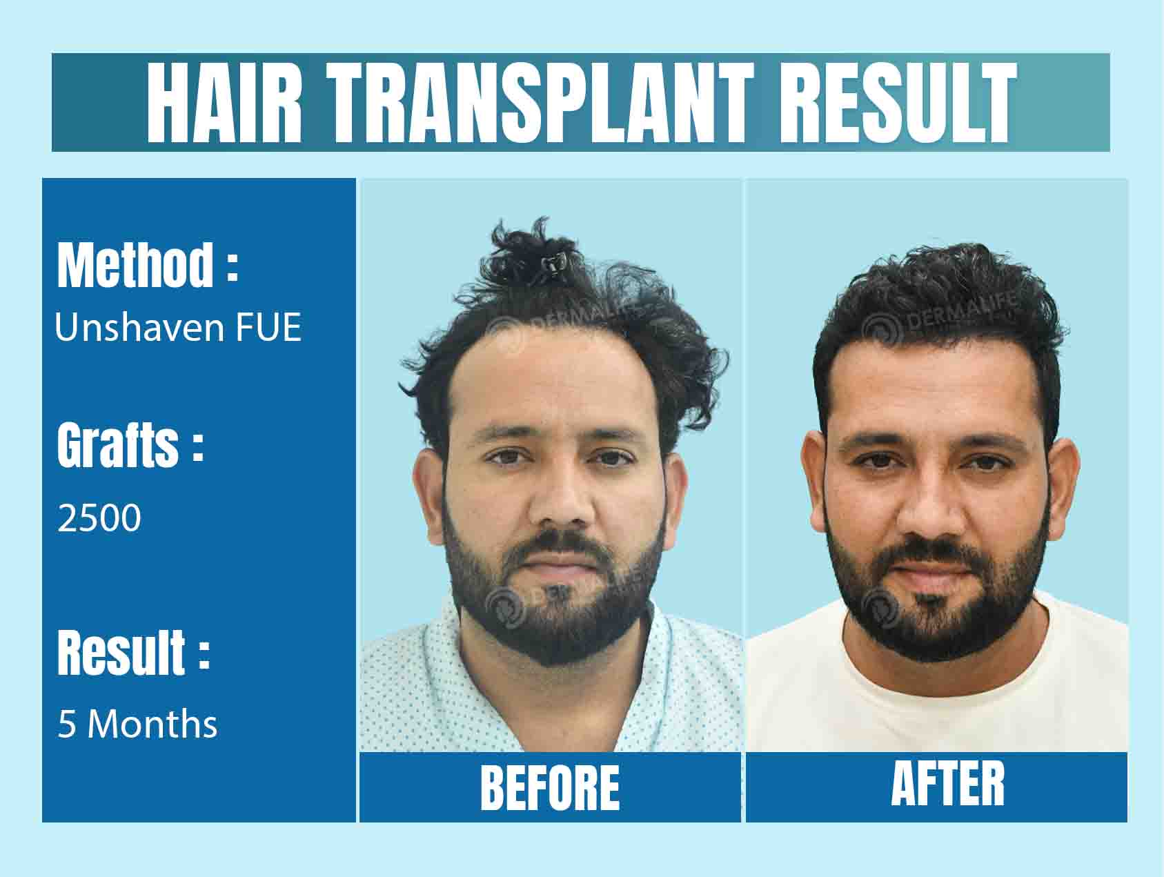 Best Hair Transplant Clinic in Delhi, India